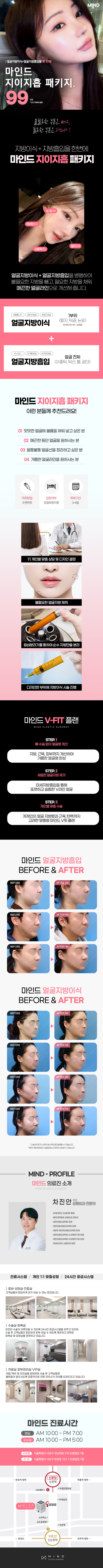 마인드 지방이식X흡입
