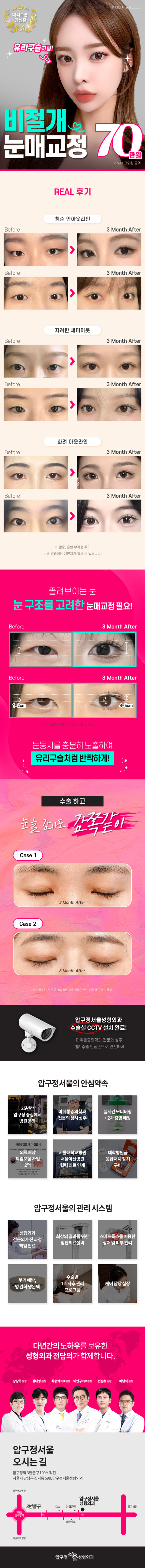 비절개눈매교정_무쌍 세미아웃 눈성형 