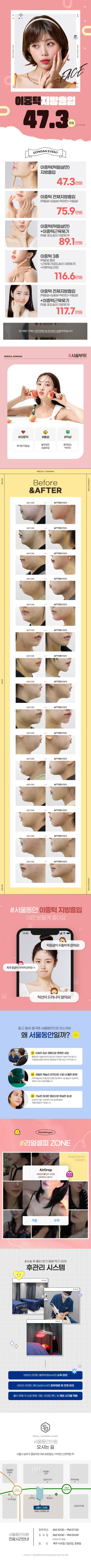 서울동안 이중턱지방흡입