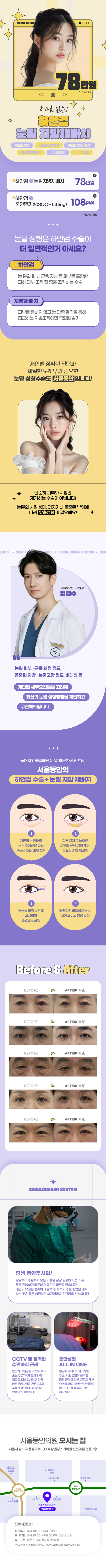 서울동안 하안검 눈밑지방재배치